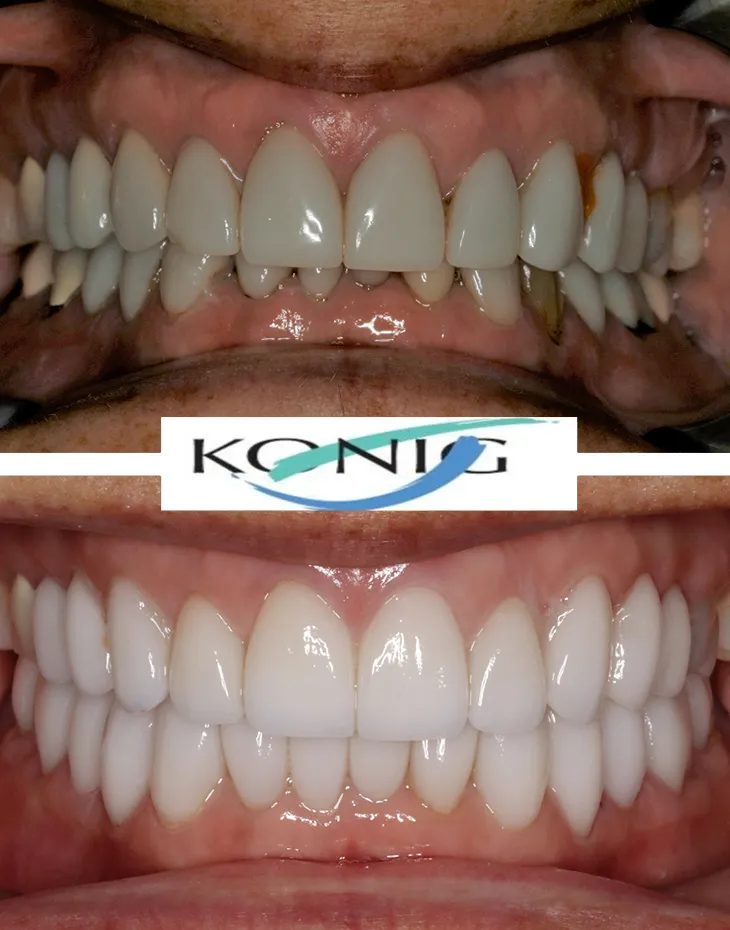 Before and after cosmetic dentistry procedures