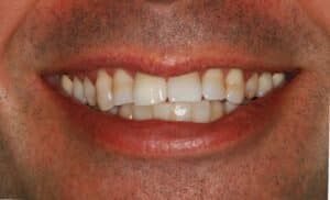 porcelain veneers