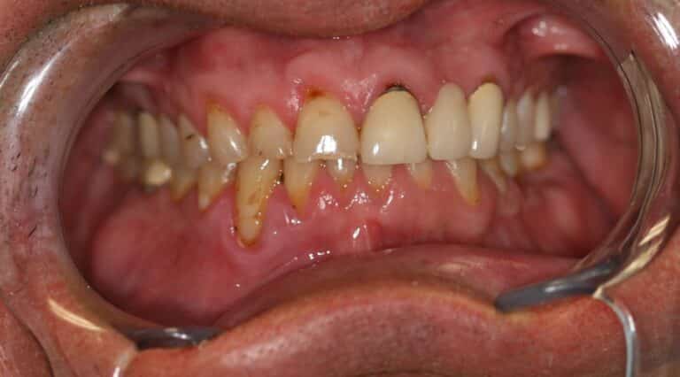 Before Image: Non surgical overbite correction, worn teeth - front