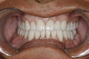 After Image: Non surgical overbite correction, worn teeth