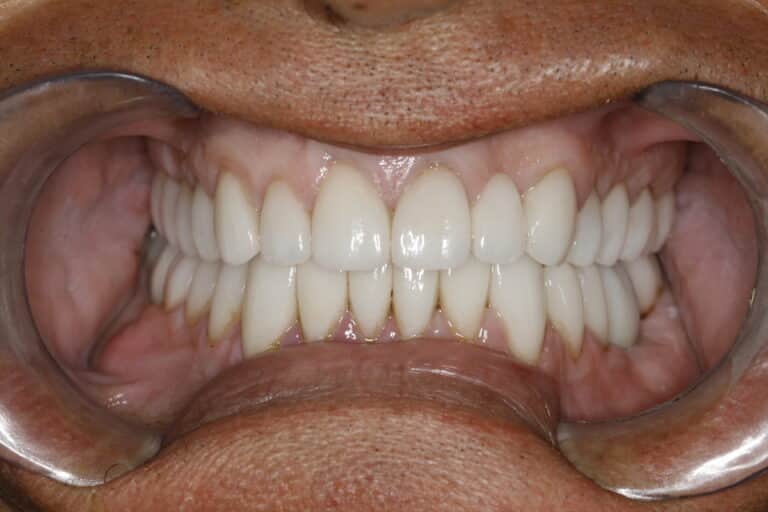 After Image: Non surgical overbite correction, worn teeth - front