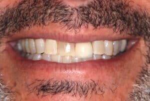 Before Image: Not all patients need 10 porcelain veneers