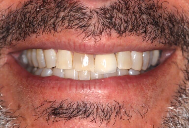 Before Image: Not all patients need 10 porcelain veneers - front