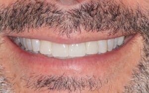 After Image: Not all patients need 10 porcelain veneers