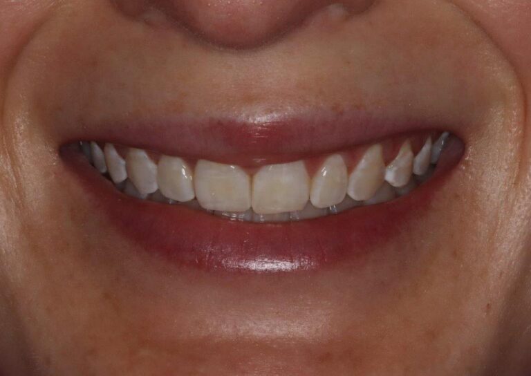 Before Image: Porcelain Veneers - front