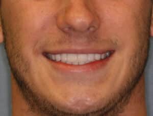 After Image: No-Prep Veneers