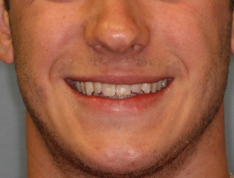 Before Image: No-Prep Veneers - front