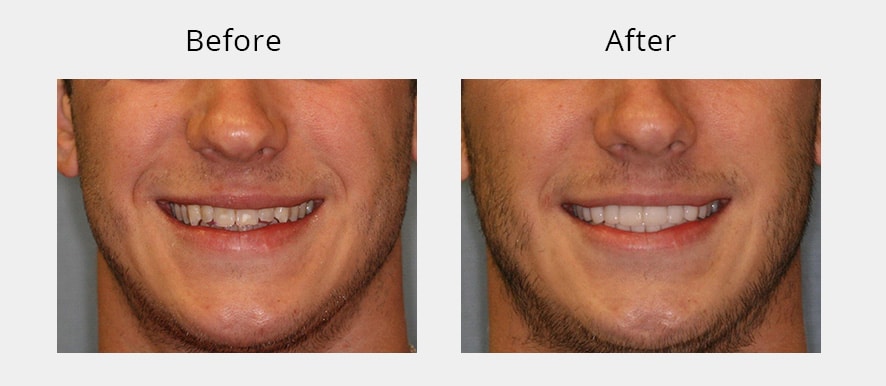 101580 No Prep Veneers before and after