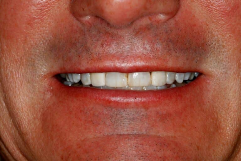 Before Image: Cosmetic Dentistry, TMJ, Non-surgical dental facelift -