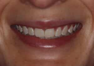 Before: Small teeth with discoloration