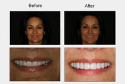 overbite correction